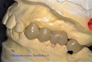 METODI DI RIPARAZIONE DI PROTESI FISSE METALLO-CERAMICA – Odontotecnica  Bardulos