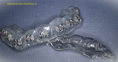 Dispositivo Ortodontico Preregolato -Metodo indiretto